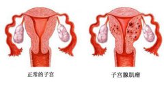 多囊卵巢综合症为何难怀孕